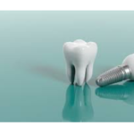 Imagem de um dente e um um implante de dente.