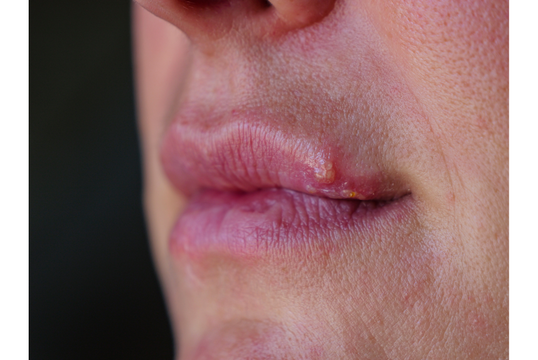 Imagem da boca de uma pessoa com ferida na boca.