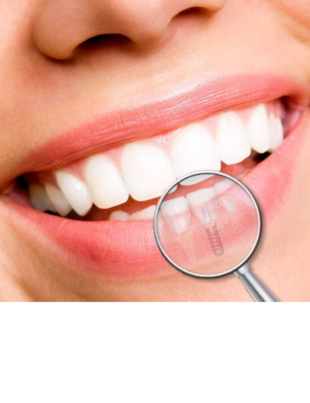 Imagem de uma boca sorrindo com os dentes brancos.