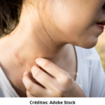 Imagem ilustrativa de uma pessoa com dermatite atópica.