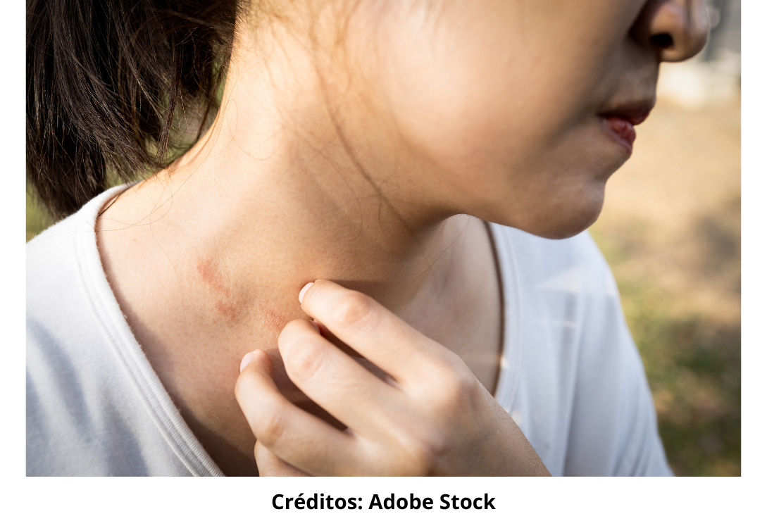 Imagem ilustrativa de uma pessoa com dermatite atópica.