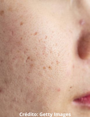 Foto ilustrativa de uma pessoa com acne.