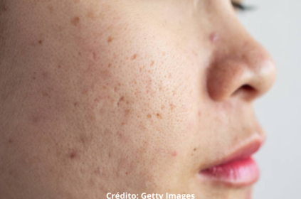 Foto ilustrativa de uma pessoa com acne.